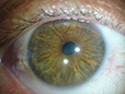Iridologia - Foto de íris obtida com o Iridophoto