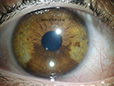 Iridologia - Foto de íris obtida com o Iridophoto